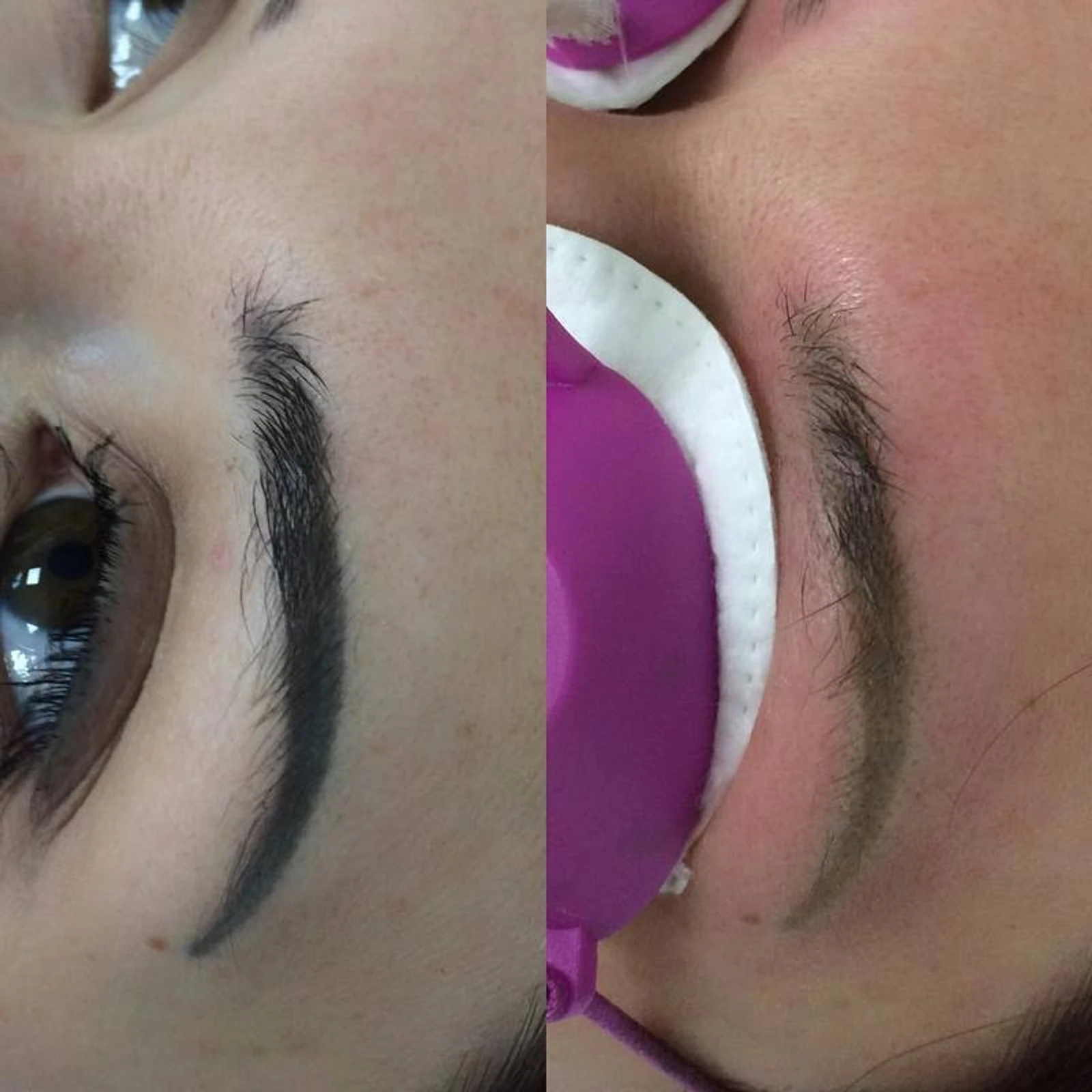 1 laser removal AP Sabenin.jpg