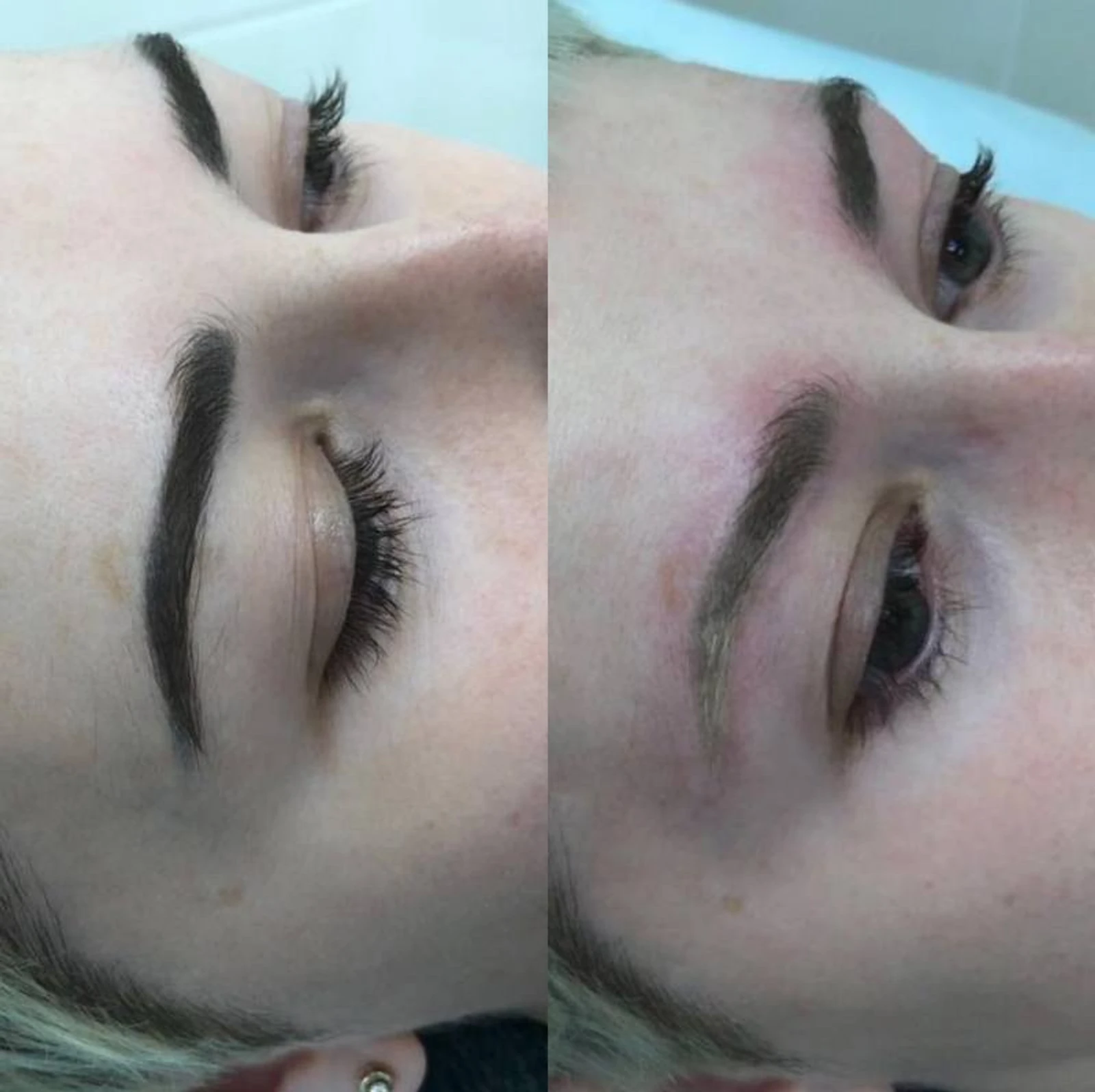 8 laser removal AP Sabenin.jpg