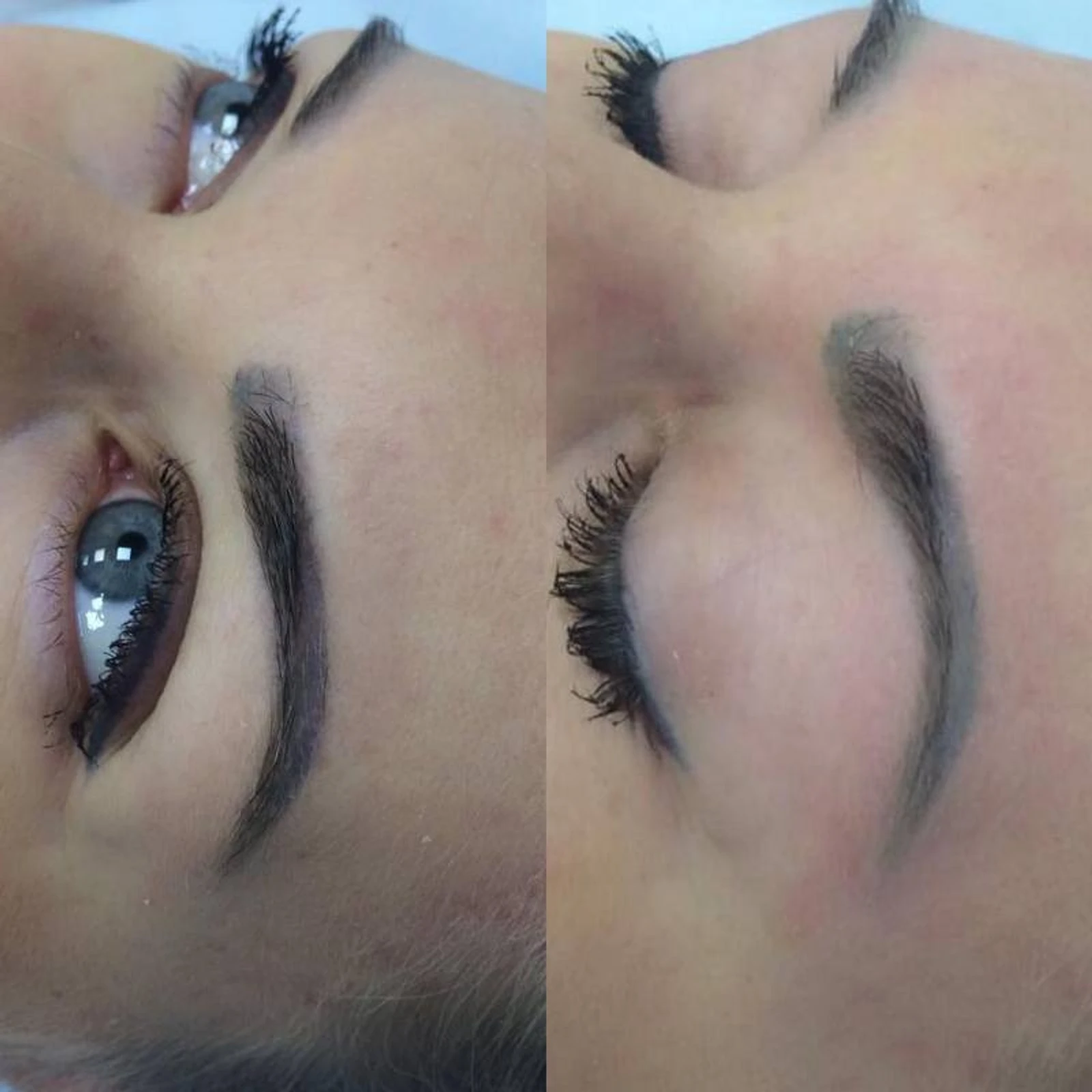 6 laser removal AP Sabenin.jpg