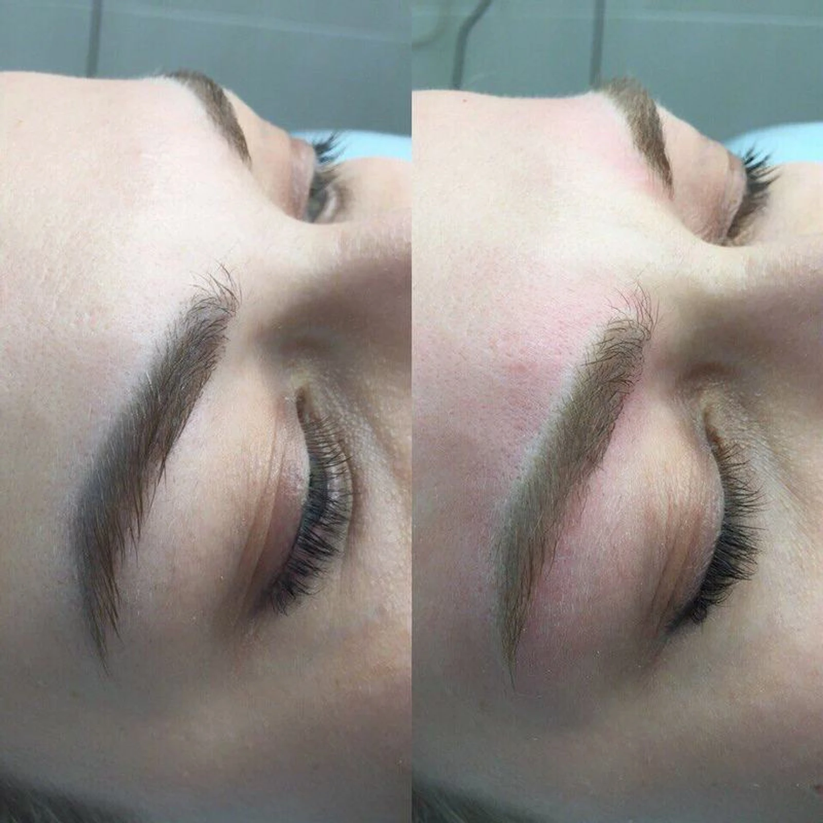 9 laser removal AP Sabenin.jpg