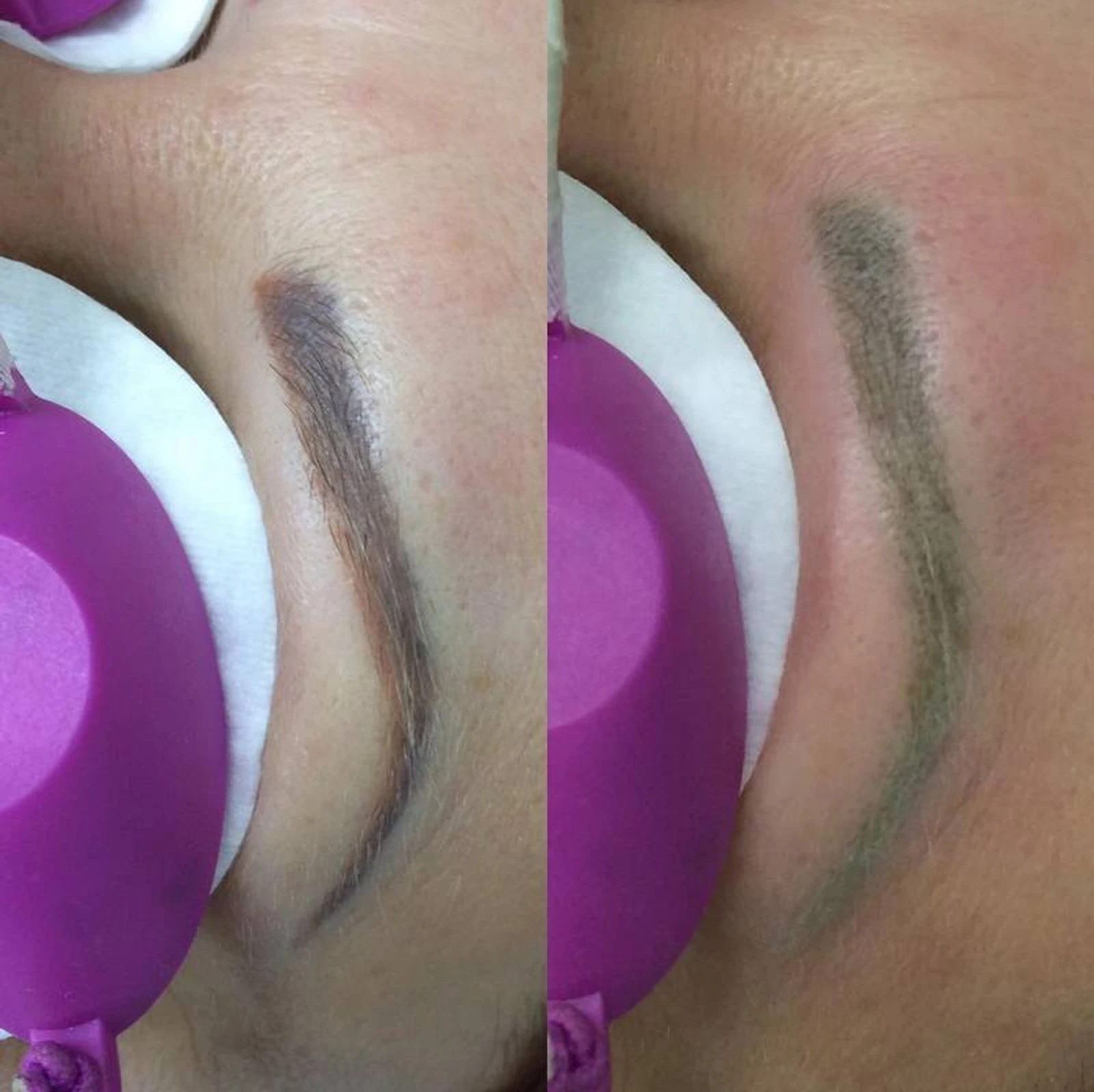 2 laser removal AP Sabenin.jpg
