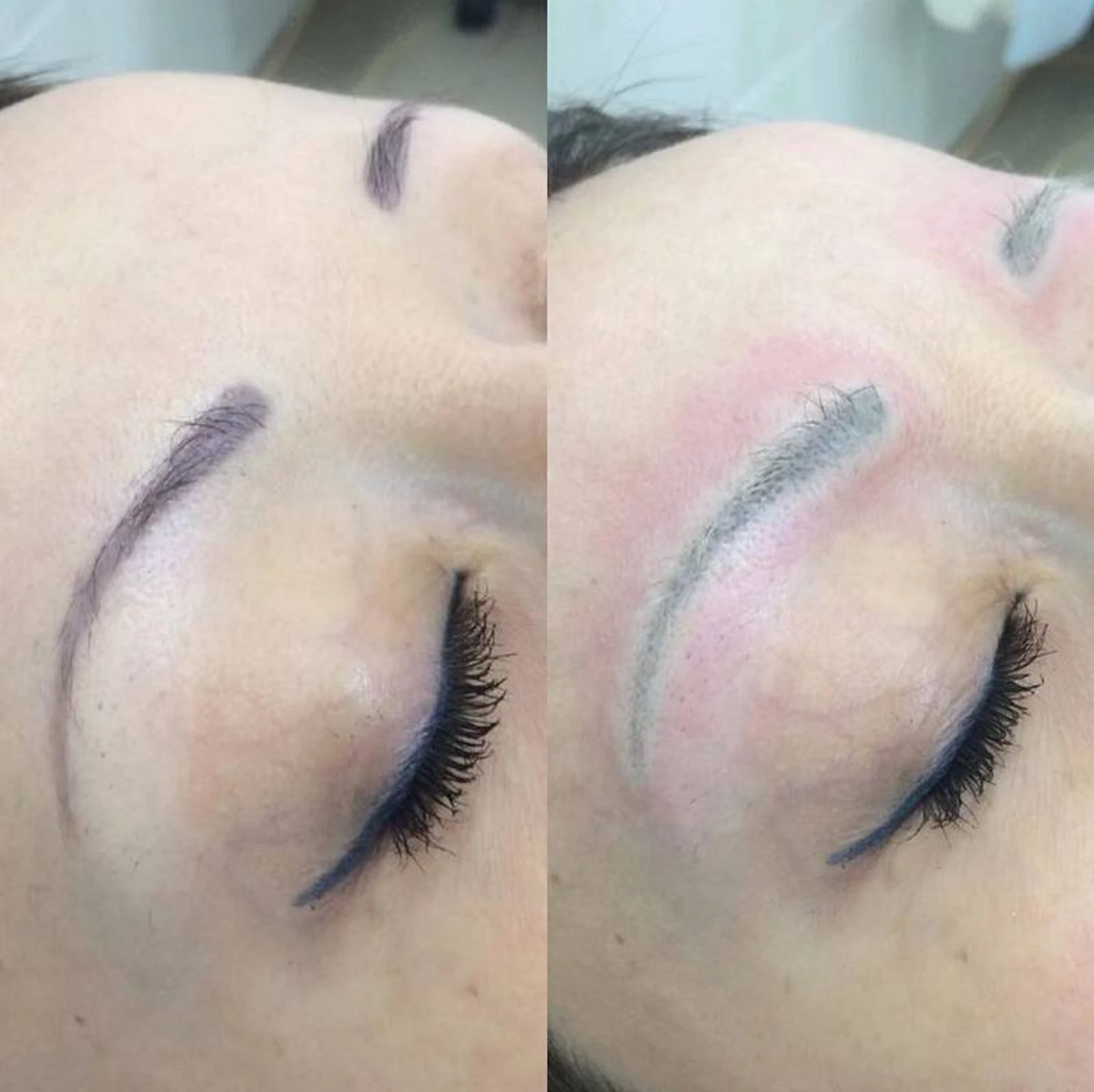 5 laser removal AP Sabenin.jpg