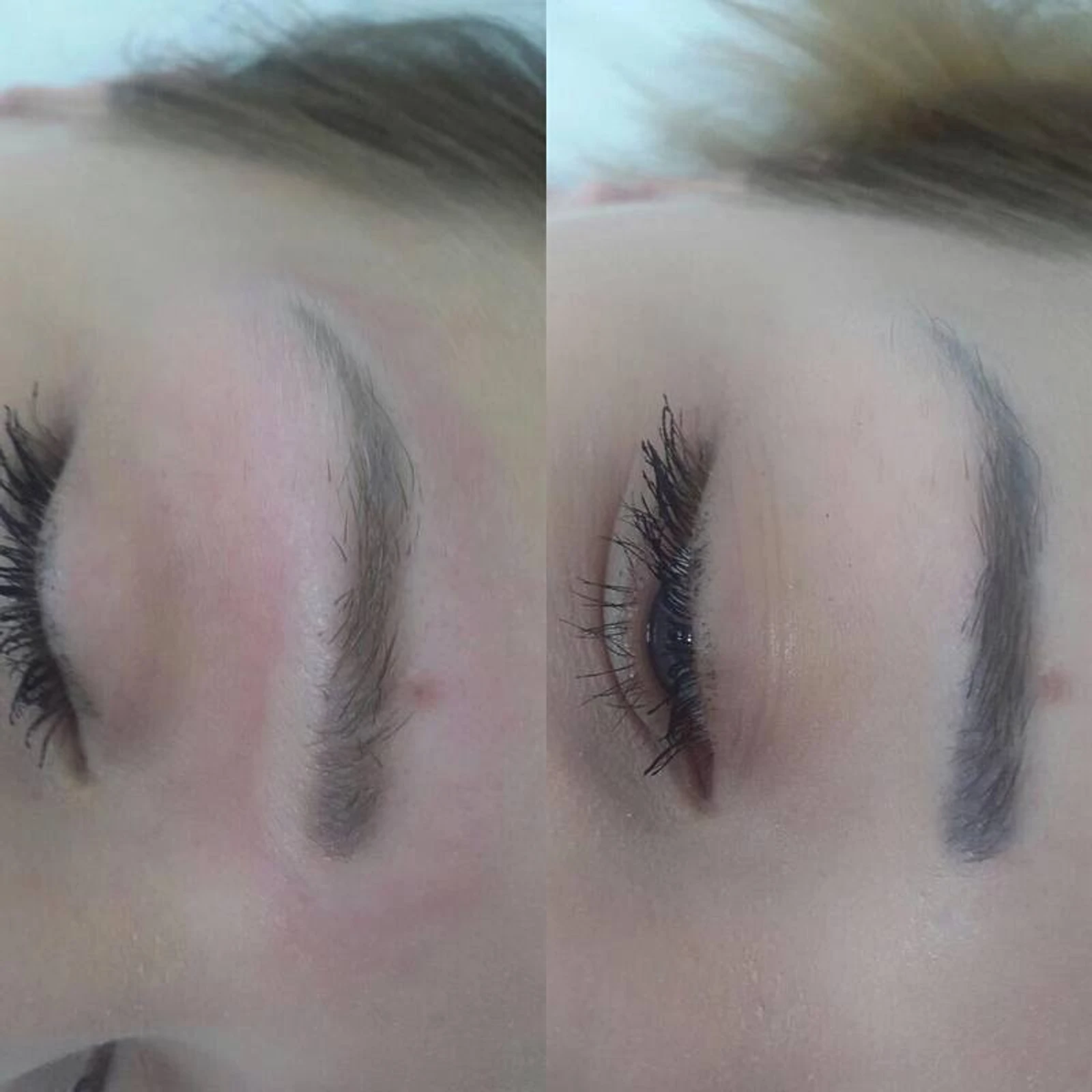 4 laser removal AP Sabenin.jpg