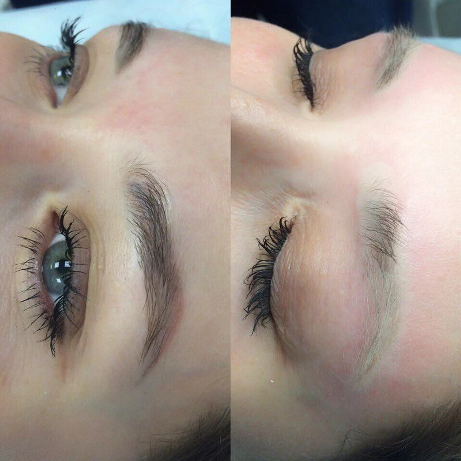 7 laser removal AP Sabenin.jpg