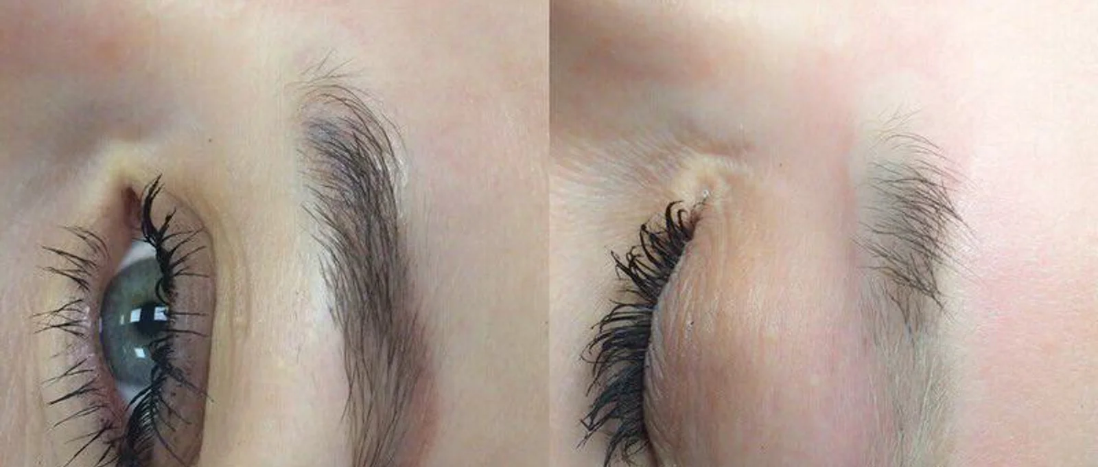 Laser Removal Course
