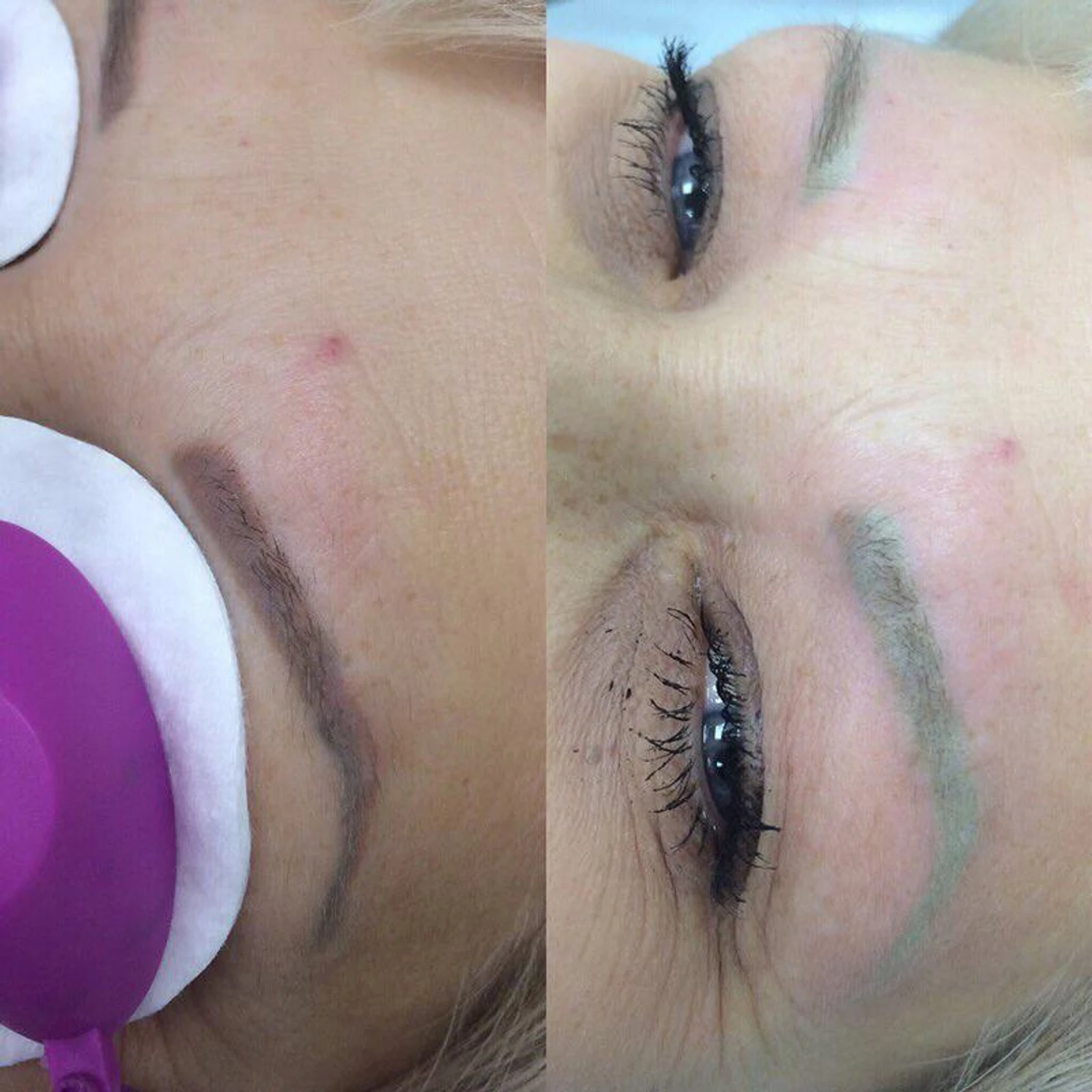 3 laser removal AP Sabenin.jpg