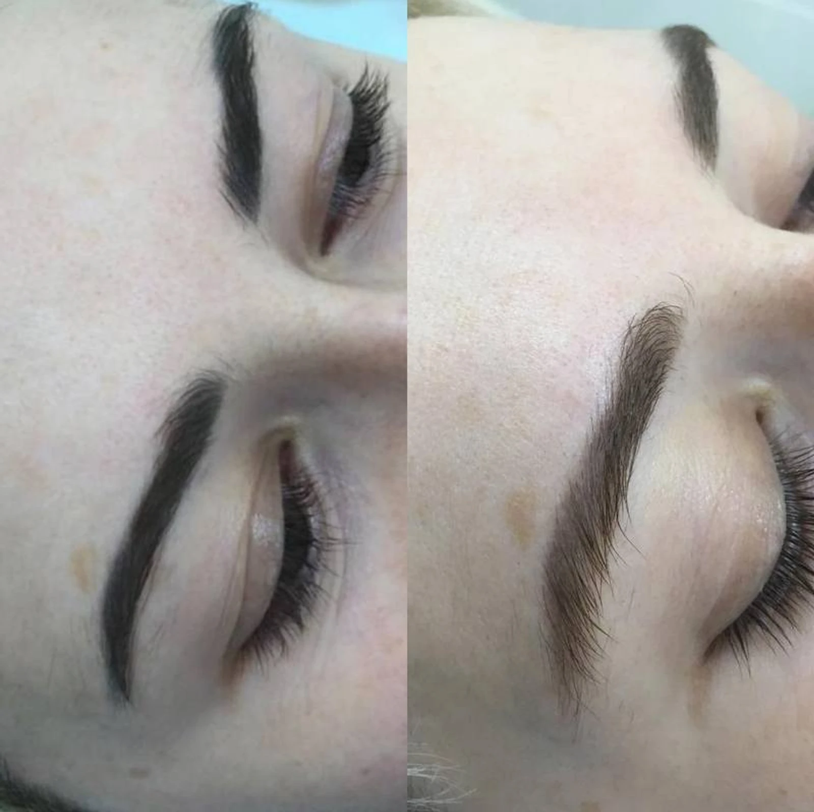 11 laser removal AP Sabenin.jpg