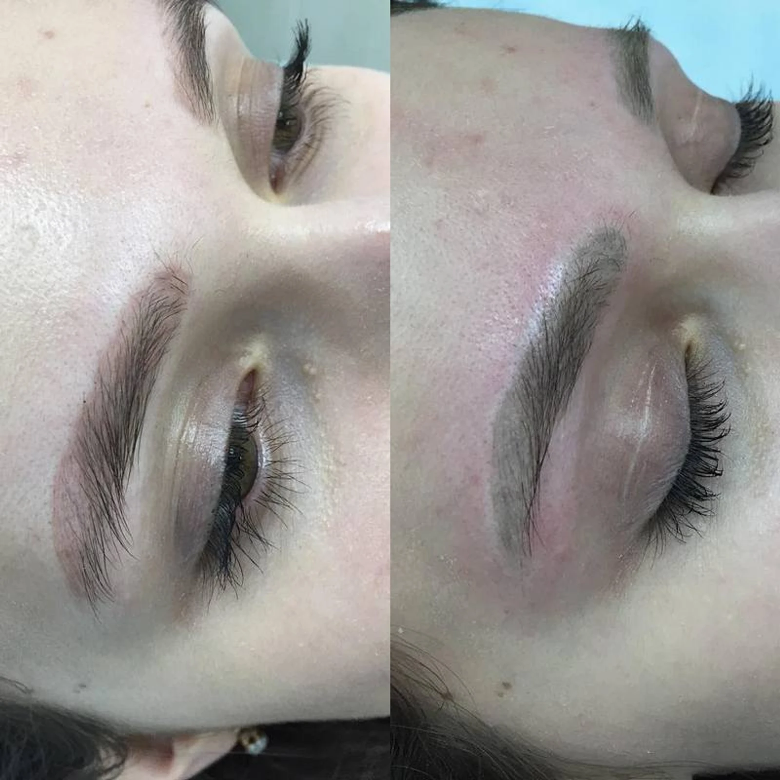 12 laser removal AP Sabenin.jpg